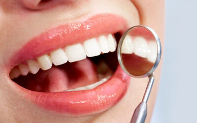 The Benefits of Professional Teeth Whitening