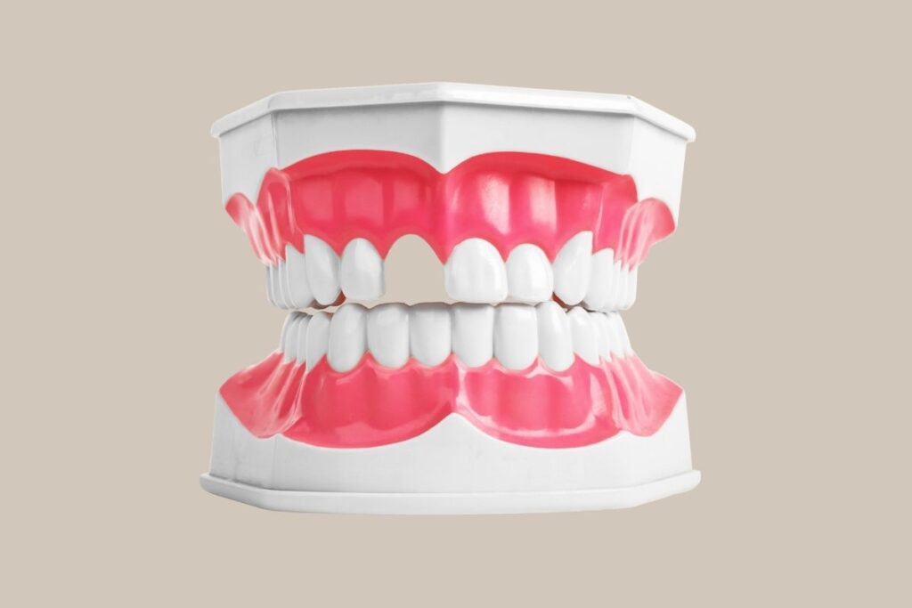 Dental model showing gums and teeth with a noticeable missing tooth, highlighting tooth loss or gap.
