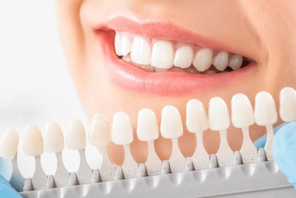 Smiling person’s teeth compared with a shade guide to plan professional whitening.
